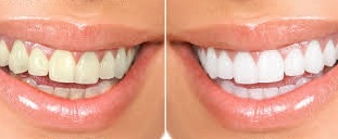 teeth whitening